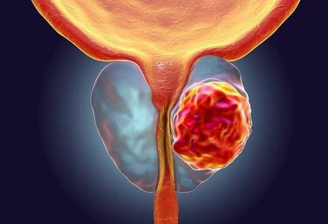 Prostate health and urinary symptoms — anatomical illustration of the prostate gland showing its relationship to the bladder and urethra in male anatomy