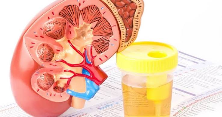 protein in urine proteinuria showing foamy urine and kidney damage from glomerular filtration barrier failure