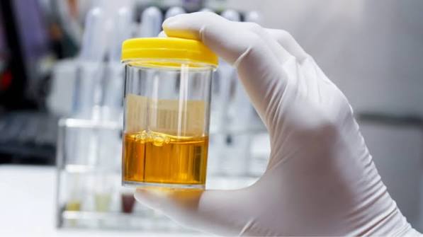 nephrotic syndrome proteinuria edema hypoalbuminemia versus nephritic hematuria RBC casts kidney inflammation
