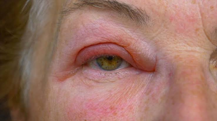puffy eyes kidney albumin oncotic pressure morning edema mechanism