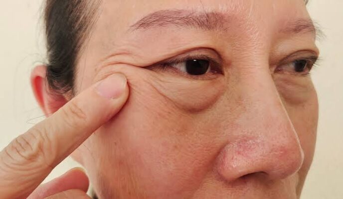 puffy eyes kidney health periorbital edema nephrotic syndrome guide