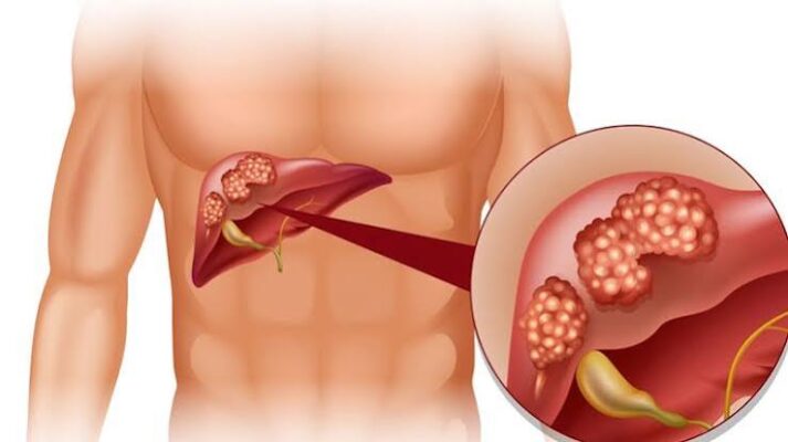 right upper abdominal pain and liver health — biliary and liver causes including gallstones, hepatitis, and liver health markers