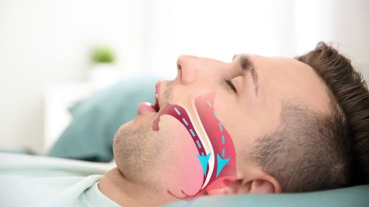 obstructive sleep apnea effects on blood glucose in people with diabetes