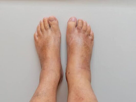 stage 3 kidney disease symptoms monitoring G3a G3b eGFR 30-59