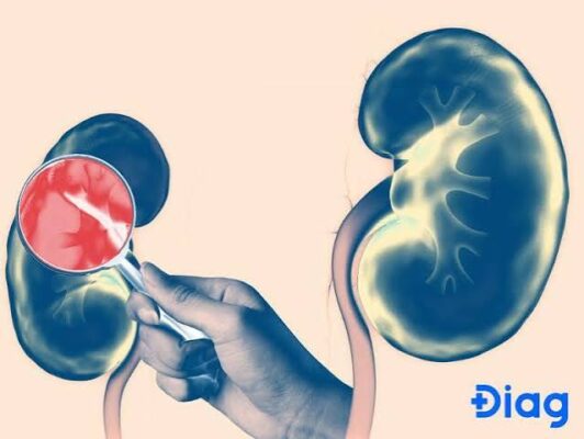 stage 4 kidney disease eGFR 15-29 symptoms KRT planning preparation