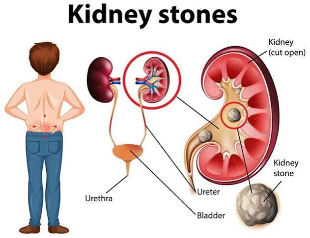stage 5 kidney disease patient discussing treatment options with nephrologist