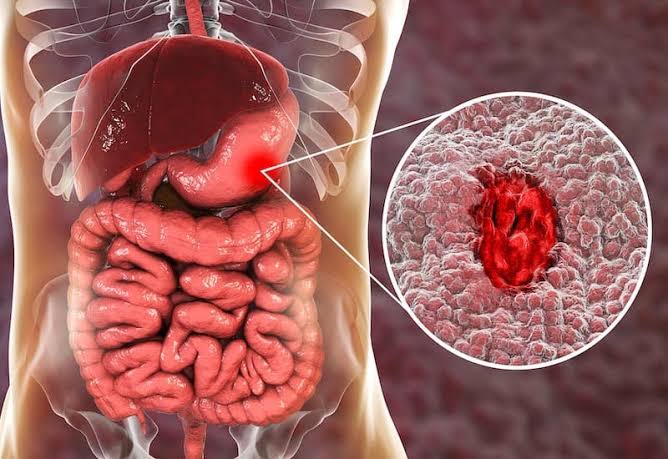 upper GI endoscopy showing stomach ulcer with stigmata of bleeding and biopsy