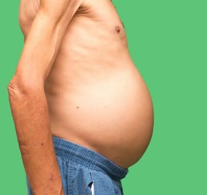 swollen belly and liver disease — ascites from cirrhosis portal hypertension and hepatic decompensation