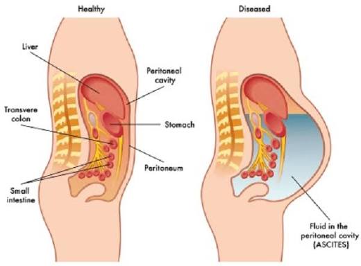 swollen-belly-and-liver-disease-body — large volume paracentesis and diuretic therapy for cirrhotic ascites