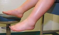 swollen feet kidney edema causes sodium retention albumin loss