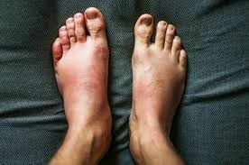 swollen feet kidney problems edema nephrotic syndrome CKD guide