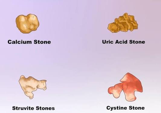 types of kidney stones — comparison chart showing calcium oxalate, uric acid, struvite, and cystine kidney stone composition and appearance