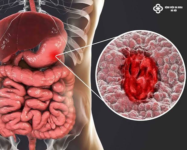 Ulcerative colitis monitoring approach showing calprotectin, colonoscopy intervals and cancer surveillance schedule