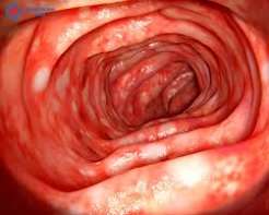 Ulcerative colitis diagram showing continuous mucosal inflammation from the rectum through the colon