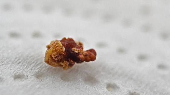 uric acid stones — smooth amber-colored kidney stone specimen characteristic of uric acid composition, contrasted with the rough surface of calcium oxalate stones