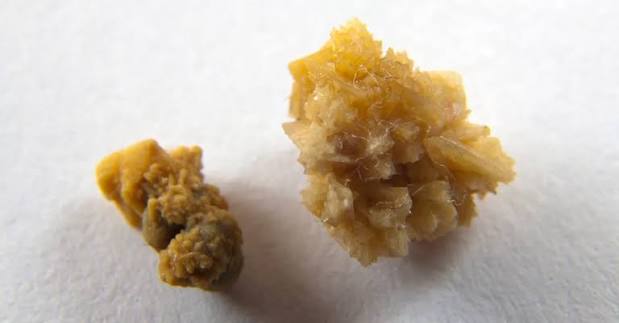 uric acid stones — smooth amber-colored kidney stone specimen showing characteristic appearance of uric acid composition compared to calcium kidney stones