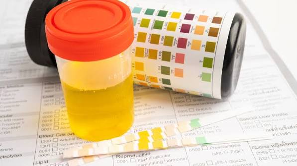 urinalysis dipstick results showing protein blood nitrite and leukocyte esterase findings for kidney and UTI screening