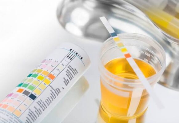 urinalysis test strip showing dipstick results for kidney disease and UTI screening