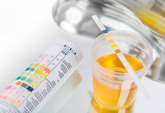 urinalysis test strip showing dipstick results for kidney disease and UTI screening