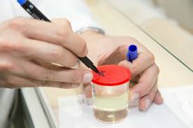 Urine culture test showing bacterial colonies on agar plate with antibiotic susceptibility results for UTI diagnosis
