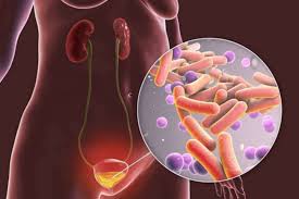 UTI vs kidney infection — side-by-side comparison showing bladder infection symptoms versus pyelonephritis symptoms including fever and flank pain