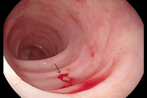 vomiting-blood-a-digestive-warning-sign-body — urgent endoscopy and risk stratification for upper gastrointestinal bleeding