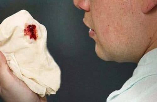 vomiting blood a digestive warning sign — hematemesis from peptic ulcer disease esophageal varices and Mallory-Weiss tear
