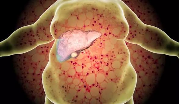 what-is-fatty-liver-disease-body — fatty liver disease spectrum steatosis MASH fibrosis cirrhosis progression