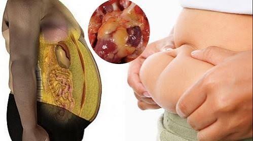 what is fatty liver disease — MASLD NAFLD steatosis liver fat accumulation hepatocytes metabolic