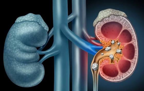 when kidney stones need medical treatment — diagram showing ureteroscopy procedure with laser lithotripsy breaking down a kidney stone for removal