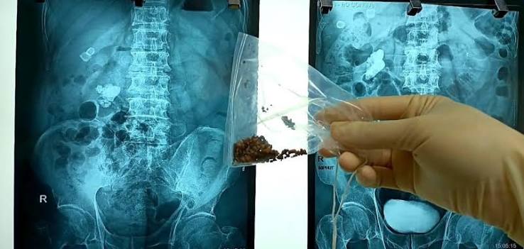 when kidney stones need medical treatment — medical professional reviewing kidney imaging with patient prior to discussing urological treatment options