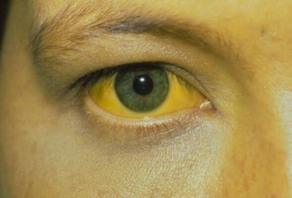 yellow skin or eyes what it may mean — jaundice from bilirubin accumulation in liver disease and bile duct obstruction
