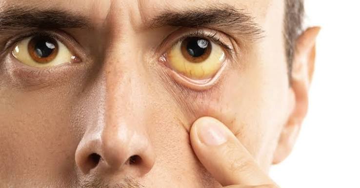 yellow-skin-or-eyes-what-it-may-mean-body — liver function tests and MRCP imaging for jaundice evaluation