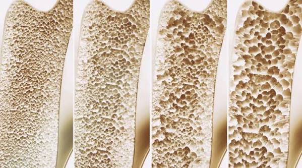 Bone density illustration showing a DEXA scan measurement of bone mineral density at the hip with T-score and Z-score results displayed and a comparison between healthy dense bone and low density osteoporotic bone