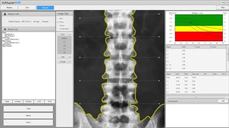 DEXA bone density test showing a patient lying on a padded table while the DEXA scanner arm moves over the hip and spine area with the bone density measurement display visible on the operator screen showing T-score and Z-score results