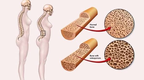 Bone health numbers every adult should know — DEXA scan results, T-scores, and calcium intake reference chart