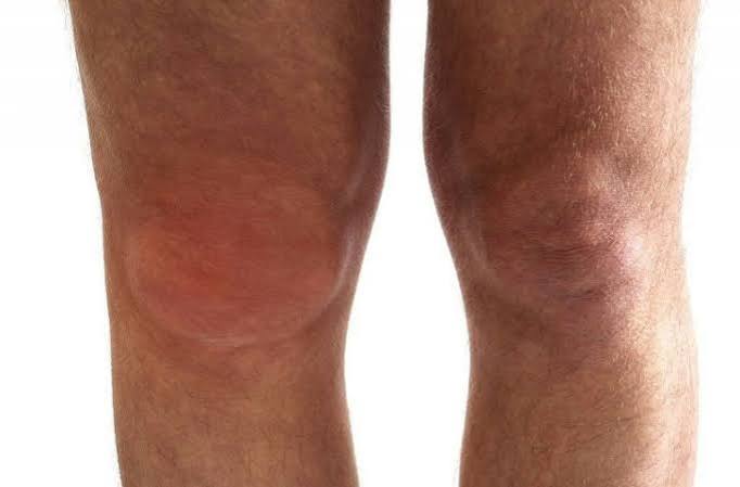 Bursitis symptoms and causes diagram showing inflamed bursae at the shoulder subacromial space, elbow olecranon, hip greater trochanter, and knee prepatellar regions with swelling and inflammation highlighted