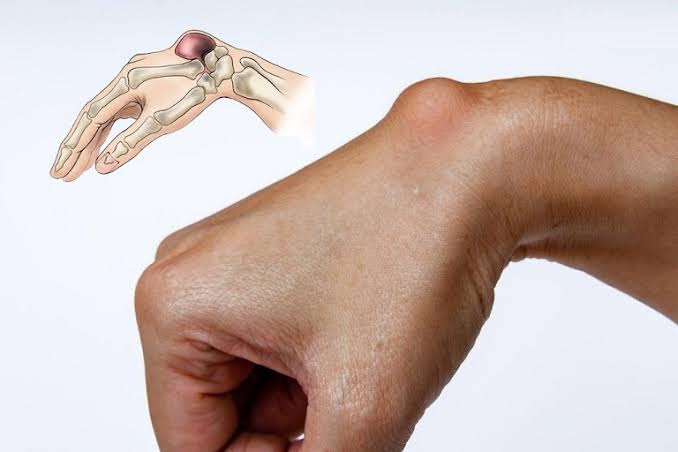 Bursitis symptoms and causes — illustration of inflamed bursae at the shoulder subacromial space, elbow olecranon, hip trochanteric, and knee prepatellar regions showing swelling and redness