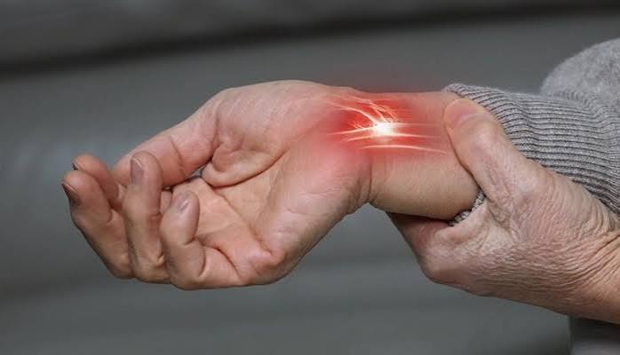 Carpal tunnel syndrome illustration showing the median nerve compressed within the carpal tunnel at the wrist with the affected sensory territory highlighted in the thumb index middle and radial half of ring finger