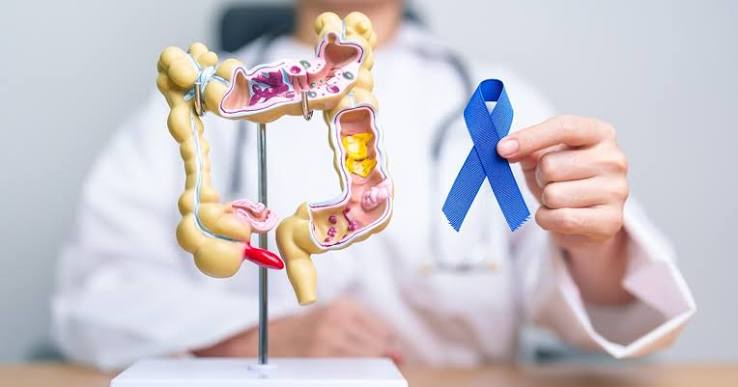 Colon cancer screening — featured image showing colorectal cancer screening process