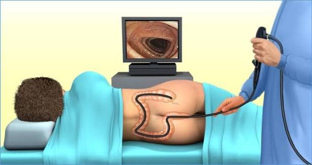 Colonoscopy preparation guide — featured image showing bowel prep process
