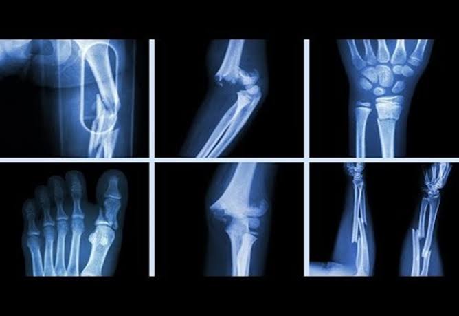Fracture risk assessment guide showing FRAX tool inputs including age sex BMI prior fracture parental hip fracture smoking glucocorticoids rheumatoid arthritis and femoral neck bone density from DEXA scan with outputs showing 10-year probability of major osteoporotic fracture and hip fracture compared against NICE age-specific intervention thresholds