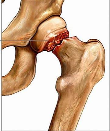 Hip fractures in older adults diagram showing femoral neck intracapsular fracture managed with hemiarthroplasty or total hip replacement and intertrochanteric extracapsular fracture managed with dynamic hip screw or intramedullary nail alongside key risk factors including osteoporosis advanced age falls history cognitive impairment and polypharmacy