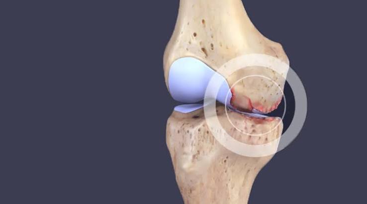 What is osteoarthritis — diagram showing cartilage loss and joint space narrowing in an osteoarthritic knee joint