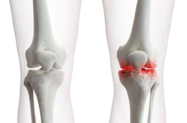 What is osteoarthritis — illustration comparing a healthy joint with articular cartilage intact against an osteoarthritic joint showing cartilage loss, subchondral sclerosis, osteophyte formation, and joint space narrowing