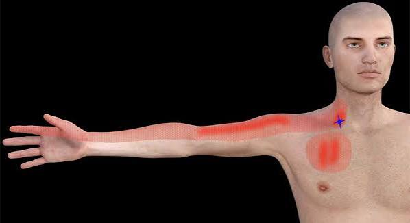 Pain that travels down the arm — adult holding neck and arm showing radiating arm pain from cervical nerve root compression