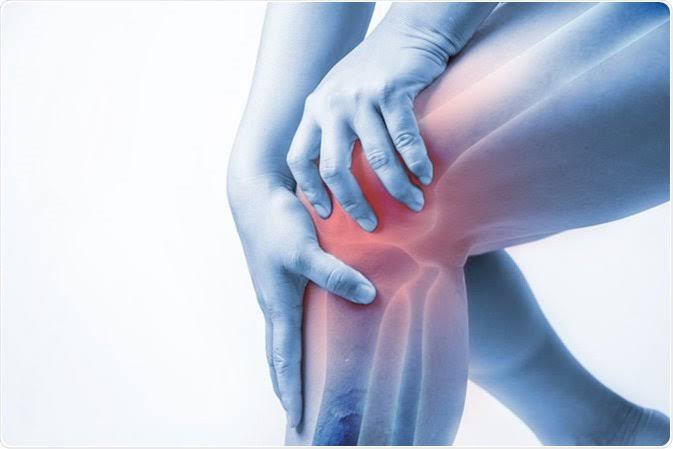 Knee osteoarthritis — diagram showing medial compartment cartilage loss, joint space narrowing, osteophytes, and subchondral sclerosis in a knee affected by OA