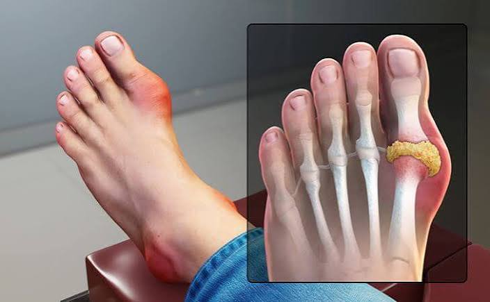 Swollen joints possible causes — close-up of swollen knee joint showing effusion from arthritis gout or injury