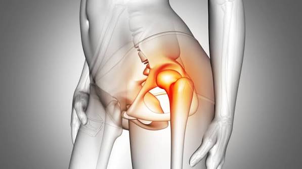 Hip osteoarthritis symptoms — diagram showing joint space narrowing, osteophytes, and cartilage loss in an osteoarthritic hip joint with the characteristic groin pain distribution