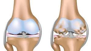 Clicking or popping joints — illustration showing the mechanisms of joint cracking including cavitation gas bubble formation in knuckles and crepitus from articular cartilage roughening in osteoarthritis